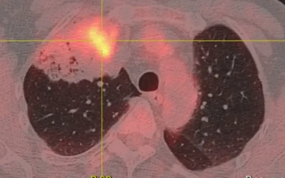 Tomographie par emission de positons